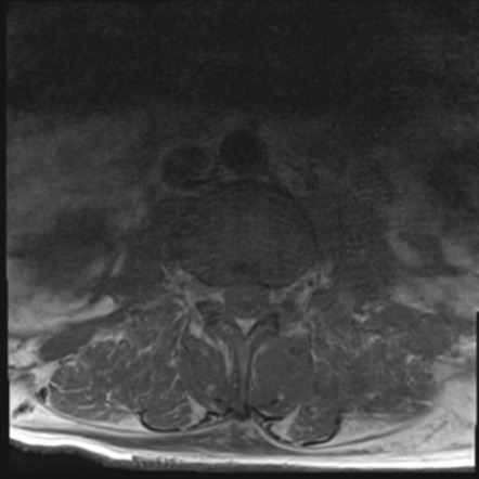 Epidural abscess | Image | Radiopaedia.org