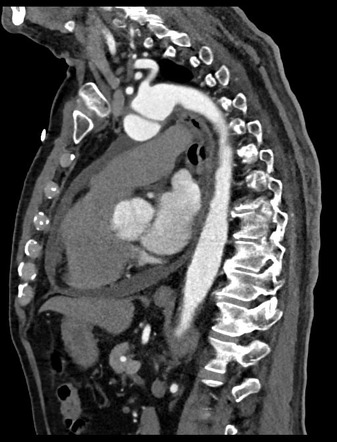 Rupturing ascending aortic pseudoaneurysms - with repair | Image ...