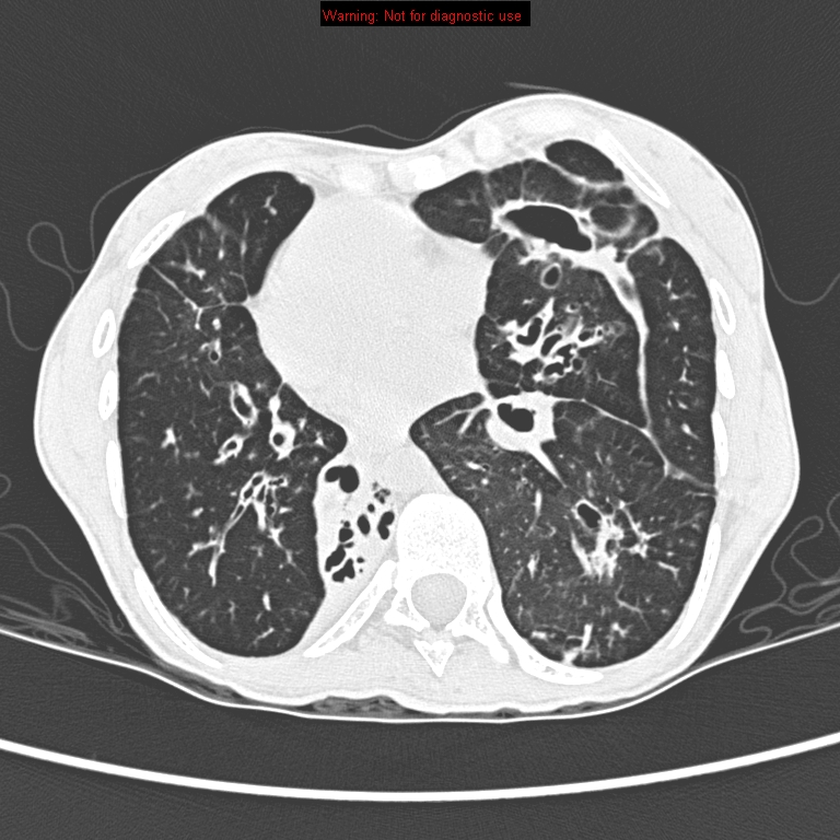 Kartagener syndrome | Image | Radiopaedia.org