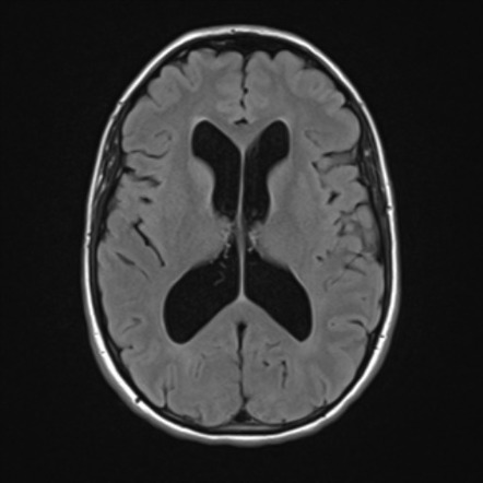 Aqueduct stenosis - web | Image | Radiopaedia.org