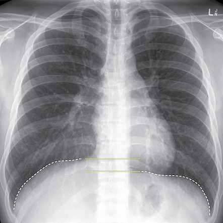 Normal position of diaphragms on chest radiography | Radiology