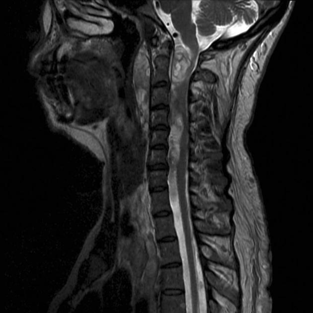 Spinal neurofibroma | Radiology Reference Article | Radiopaedia.org