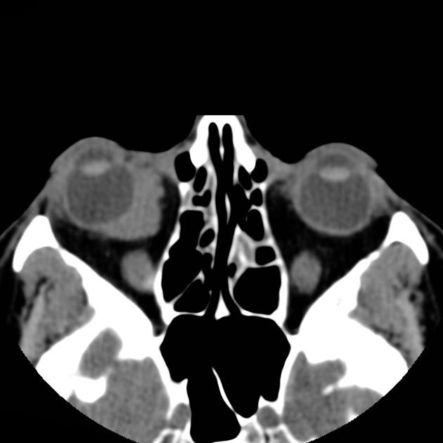 Lymphoma Radiology Reference Article 1002