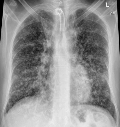 Miliary tuberculosis | Radiology Reference Article | Radiopaedia.org