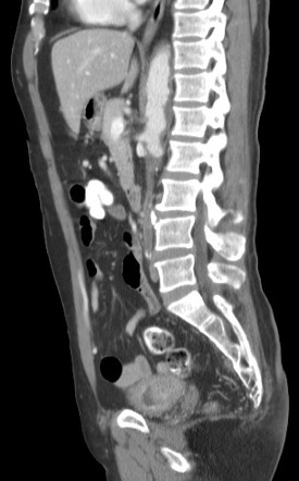 Aortoiliac occlusive disease Radiology Reference Article