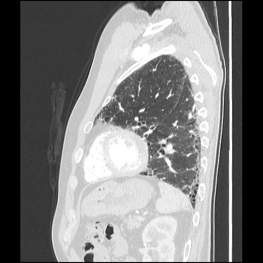 Usual Interstitial Pneumonia Uip Image