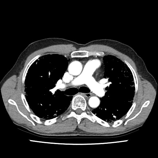 Usual Interstitial Pneumonia Uip Image