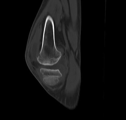 Congenital insensitivity to pain | Image | Radiopaedia.org