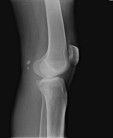 Ossified bodies in popliteal cyst | Image | Radiopaedia.org