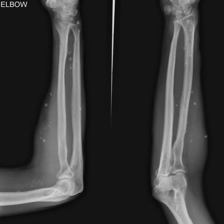 phleboliths radiopaedia radiology