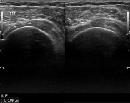 Supraspinatus tear | Image | Radiopaedia.org