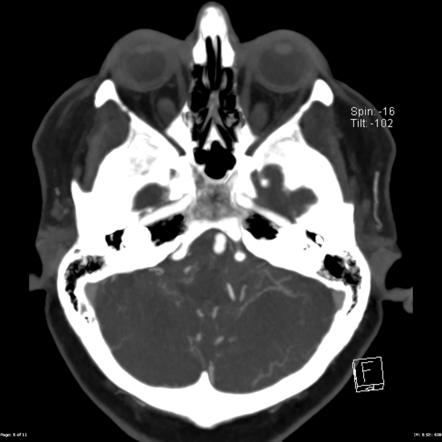 Subarachoid hemorrhage: posterior inferior cerebellar artery aneurysm ...