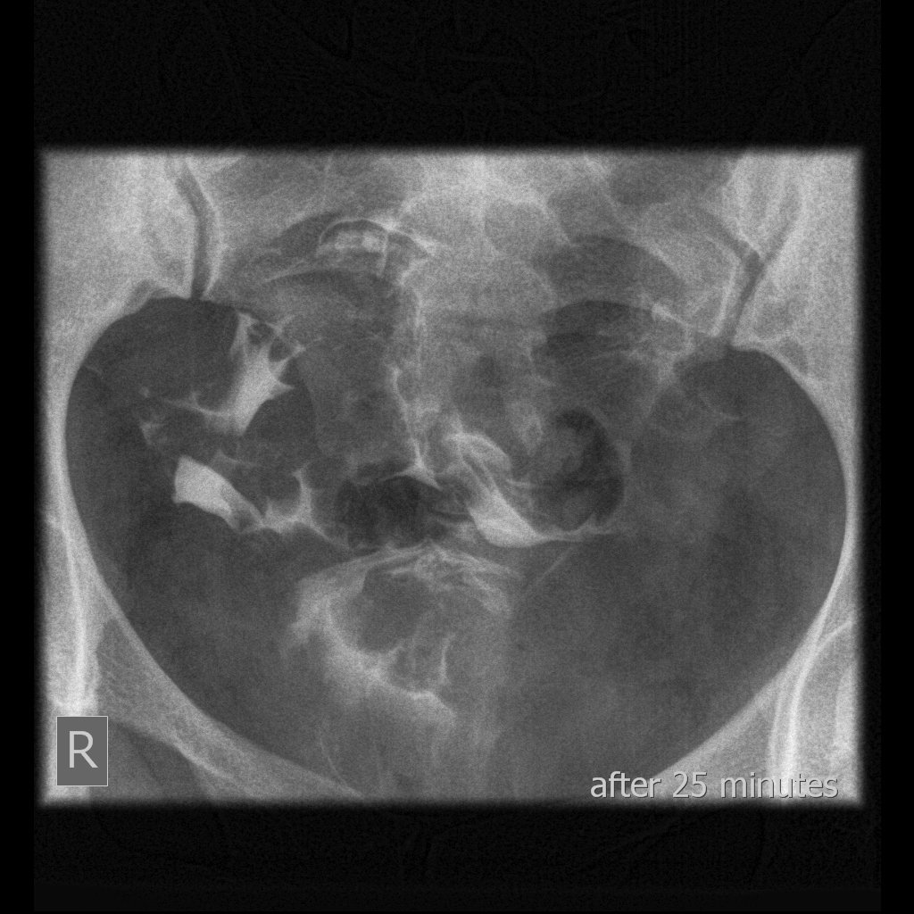 Bicornuate/septate Uterus | Image | Radiopaedia.org