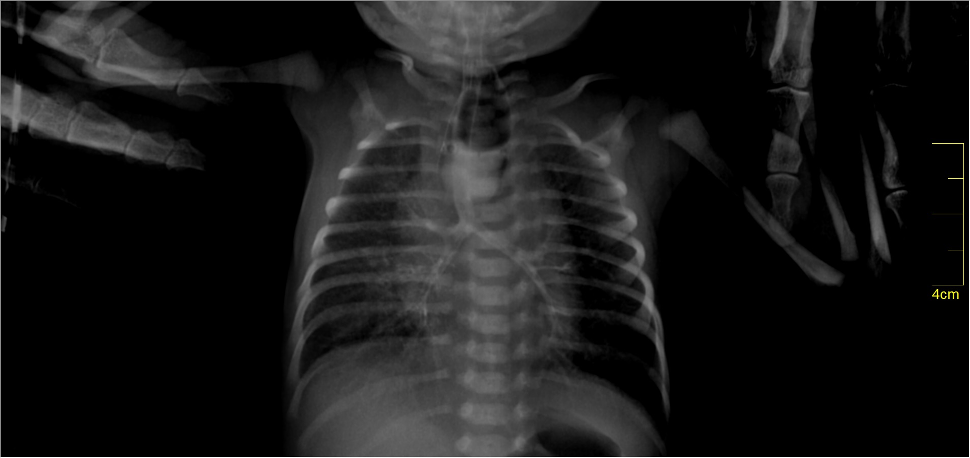 Esophageal Atresia With Distal Tracheo Esophageal Fistula Image