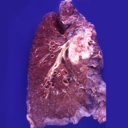 Lung Neoplasms 