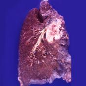 Lung cancer | Radiology Reference Article | Radiopaedia.org