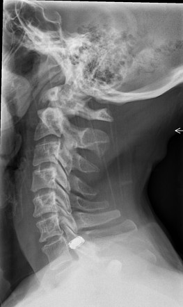 Os odontoideum | Image | Radiopaedia.org