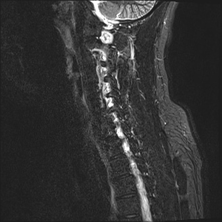 Apical Lung Mass Mimic - Neurogenic Tumor 