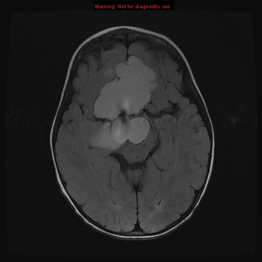 Craniopharyngioma | Image | Radiopaedia.org