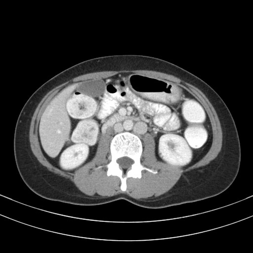 Duplicated Inferior Vena Cava 