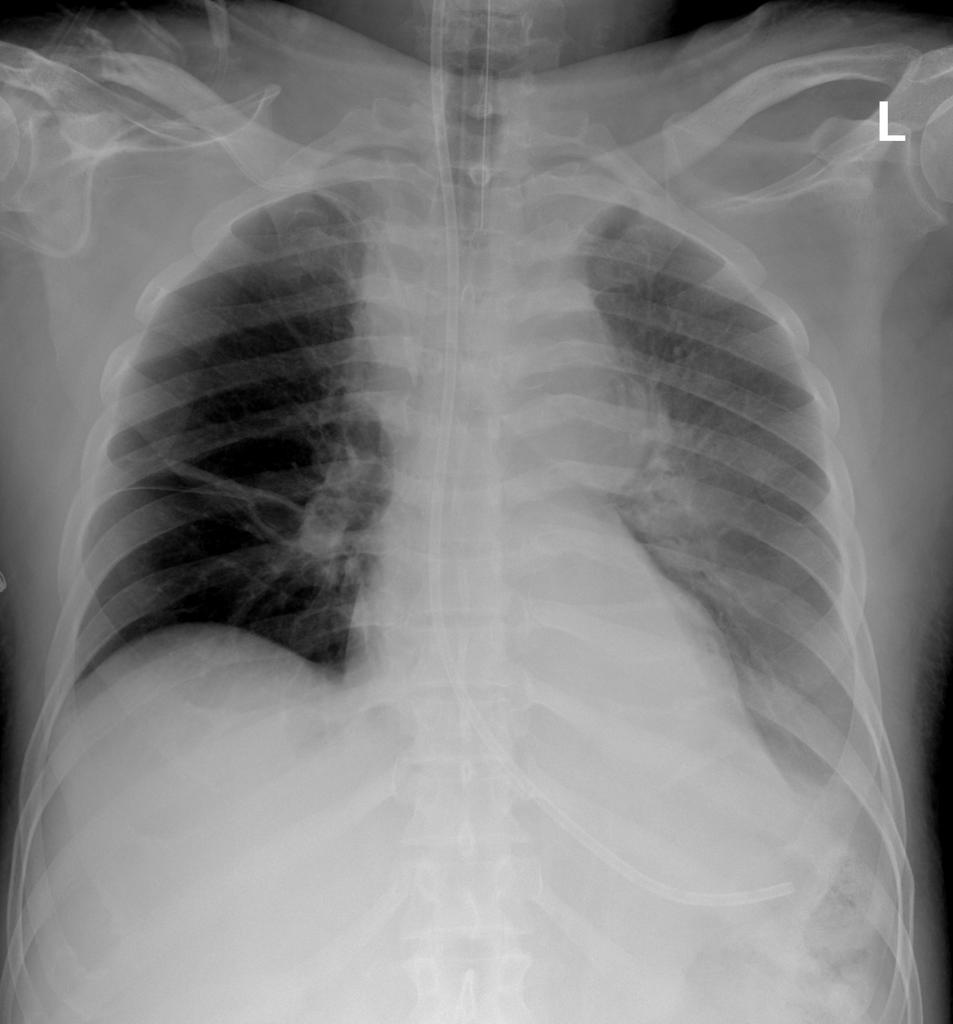 Thoracic Aortic Disruption