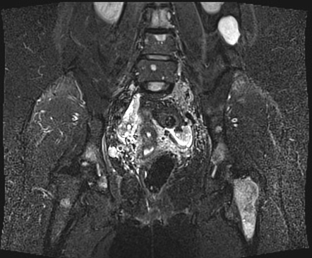 Metastatic thigh liposarcoma | Image | Radiopaedia.org