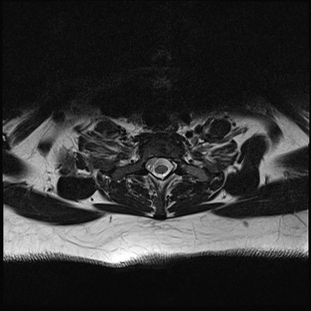 Metastatic thigh liposarcoma | Image | Radiopaedia.org