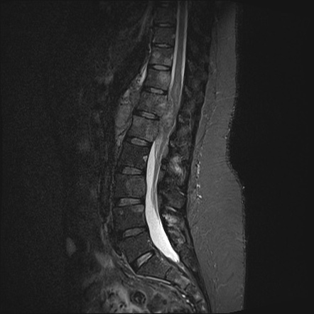 Metastatic thigh liposarcoma | Image | Radiopaedia.org