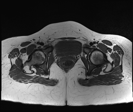 Metastatic thigh liposarcoma | Image | Radiopaedia.org