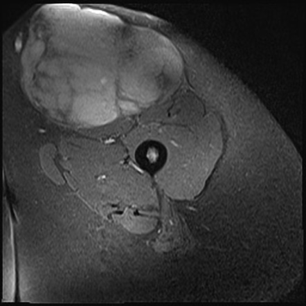 Metastatic thigh liposarcoma | Image | Radiopaedia.org