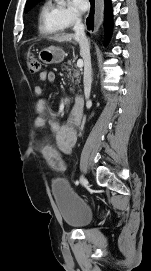 Small bowel perforation due to chicken bone, with incidental gastric ...