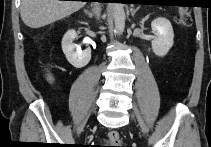 File:Small bowel perforation due to chicken bone, with incidental ...