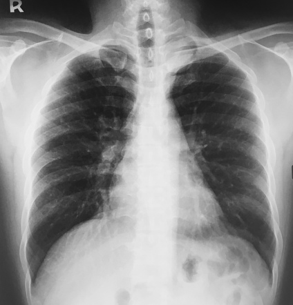 Playlist 'Pulmonary Neoplasms and Tumour Mimics' by Dr K Hussain