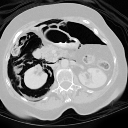 Pneumoperitoneum and pneumoretroperitoneum | Image | Radiopaedia.org