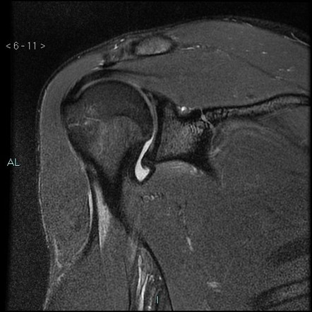 Fibrous Bankart lesion | Image | Radiopaedia.org