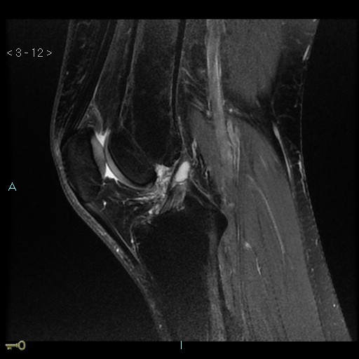 Anterior Cruciate Ligament Ganglion Cyst 