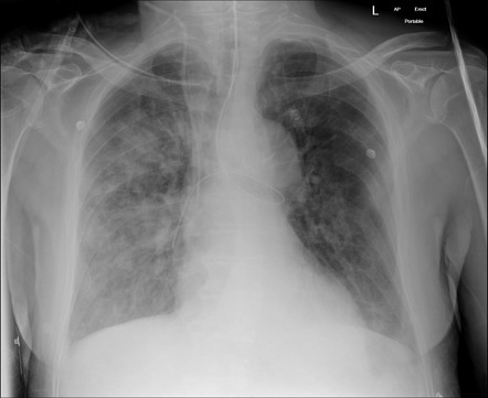 Endobronchial nasogastric tube | Radiology Case | Radiopaedia.org