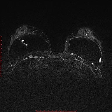 Intracapsular breast implant rupture | Image | Radiopaedia.org