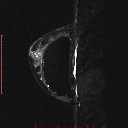 Intracapsular breast implant rupture | Image | Radiopaedia.org