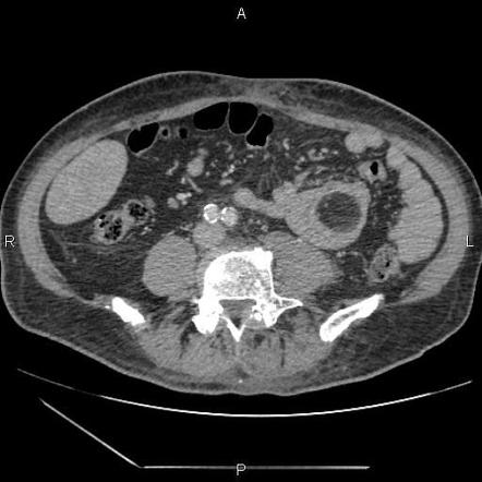 Duodenal lipoma with intussusception | Radiology Case | Radiopaedia.org