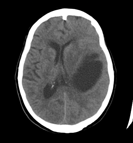 Arachnoid cyst with mass effect | Image | Radiopaedia.org