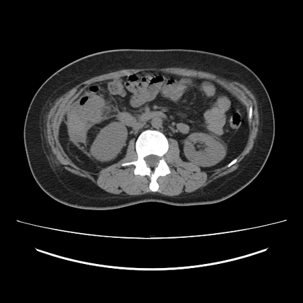 Ascending retrocecal appendicitis with liver abscesses | Radiology Case ...