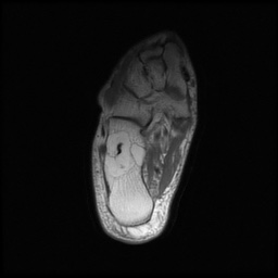 Calcaneal lipoma | Image | Radiopaedia.org