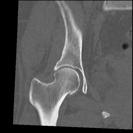 Normal Ct Hip Image 0041