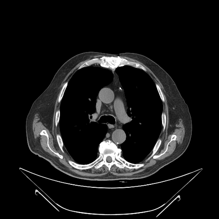 Pulmonary embolism | Radiology Case | Radiopaedia.org