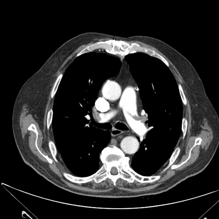 Pulmonary Embolism 