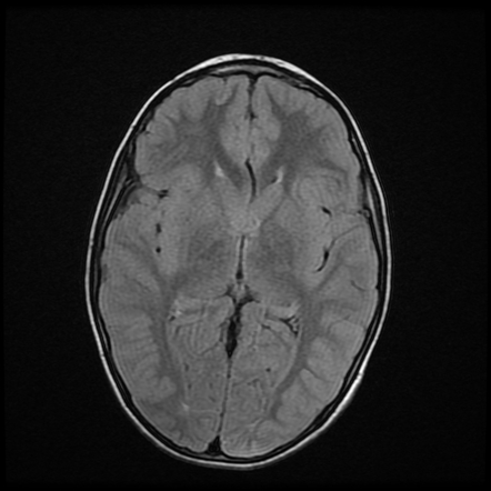 Epidermoid cyst | Radiology Case | Radiopaedia.org