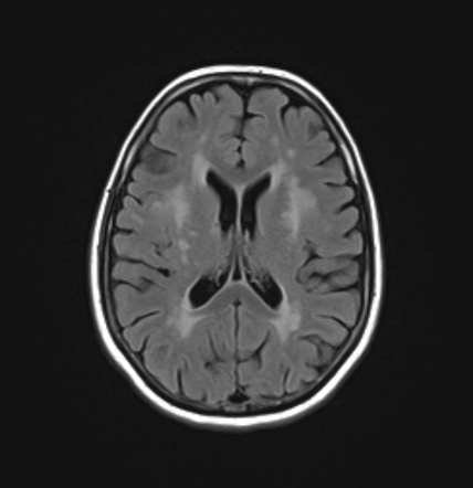 Cerebral autosomal dominant arteriopathy with subcortical infarcts and ...