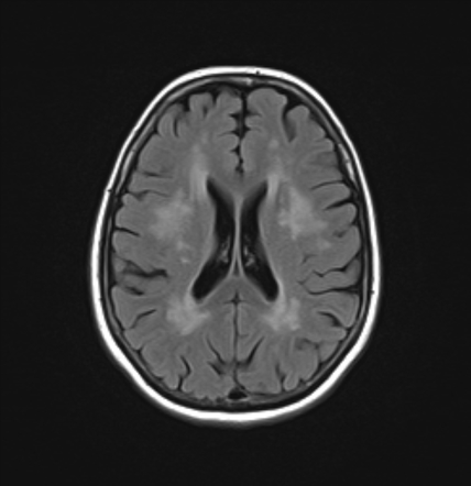 Cerebral autosomal dominant arteriopathy with subcortical infarcts and ...