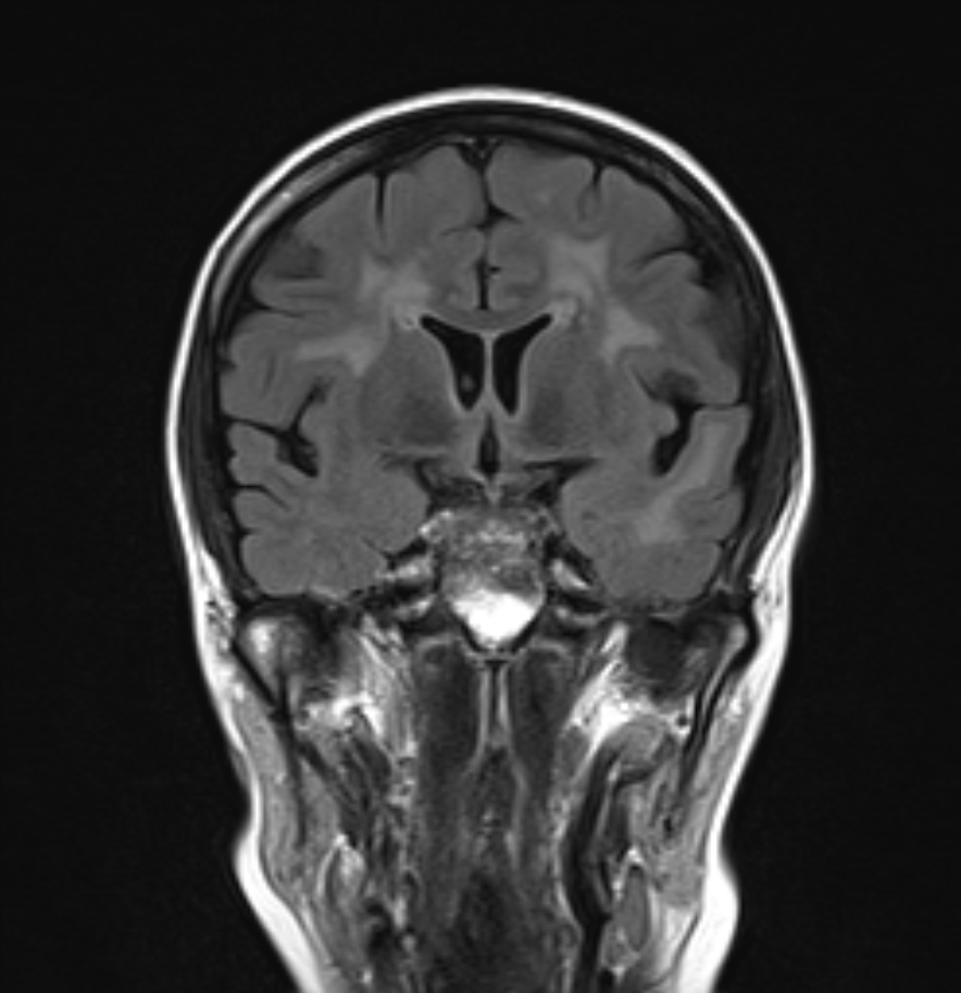 Cerebral Autosomal Dominant Arteriopathy With Subcortical Infarcts And Leukoencephalopathy